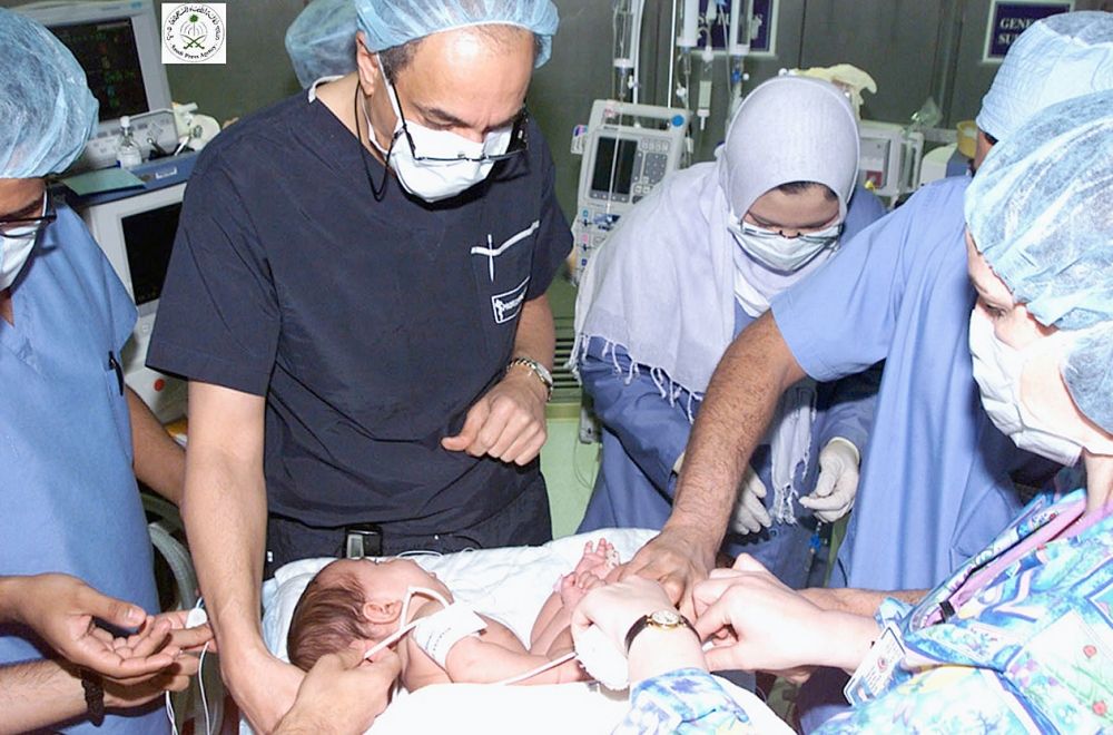 عملية فصل التوأمتين السيامييتين المصريتين تاليا وتالين