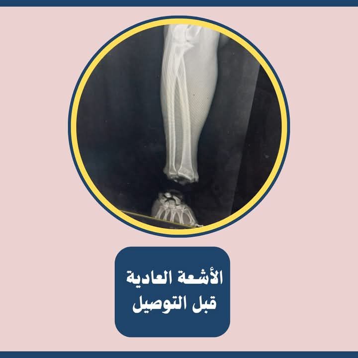 الأشعة قبل عملية التوصيل الأشعة قبل عملية التوصيل