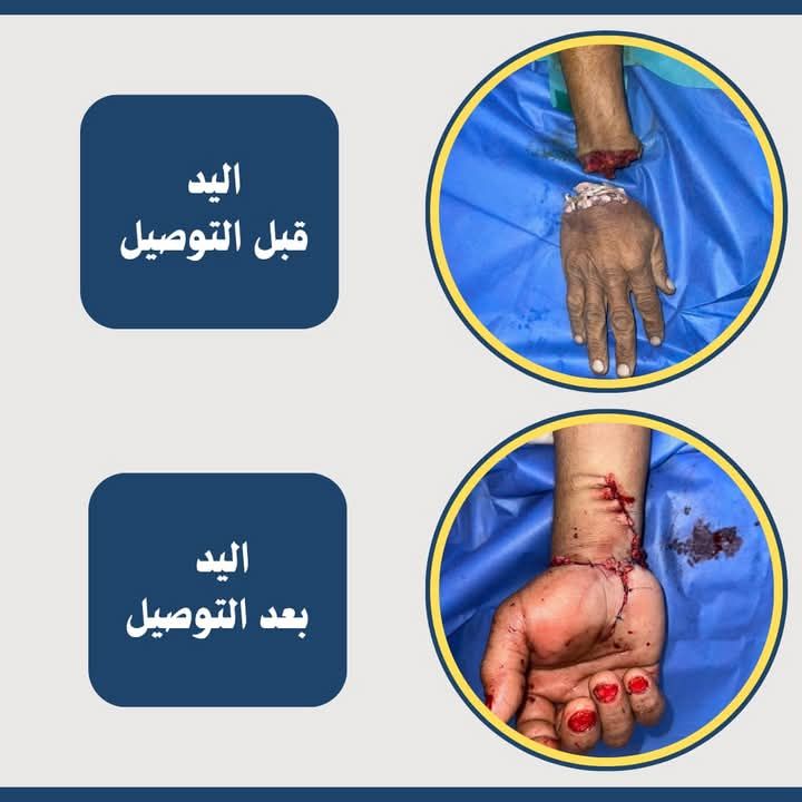الكف المبتور قبل وبعد التوصيل الكف المبتور قبل وبعد التوصيل