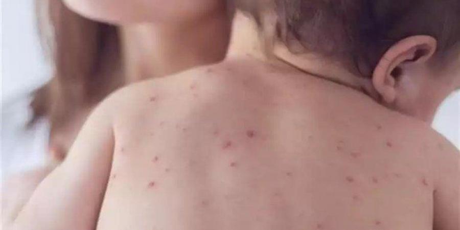 الحصبة
      تعود
      بقوة
      إلى
      الولايات
      المتحدة:
      أكثر
      من
      ألف
      إصابة
      مؤكدة
      و3
      وفيات..
      ماذا
      يحدث؟ - تكنو بلس